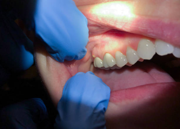 Best Knocked-Out Tooth (Avulsed Tooth) Treatment in Turley, OK